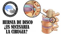 ¿Es necesaria la cirugia de hernia discal?