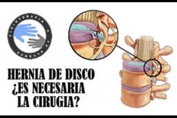 ¿Es necesaria la cirugia de hernia discal?